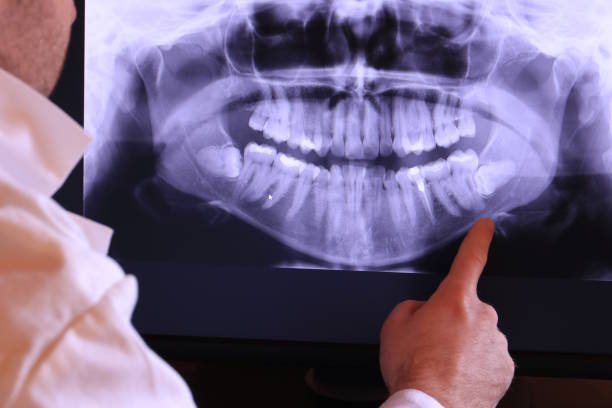 Best Emergency Dentist for Lost Fillings or Crowns in Southport, IN